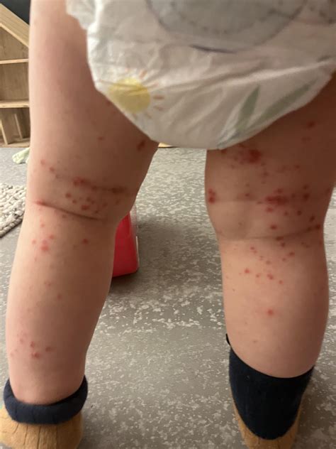 Is this Bowenoid Papulosis? Been here for 10yrs with no change besides
