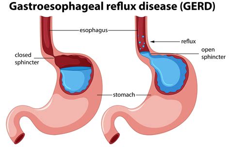 Gerd System Disorder Template