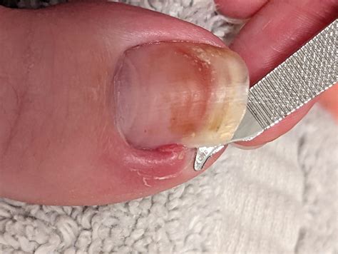Mild Ingrown Toenail