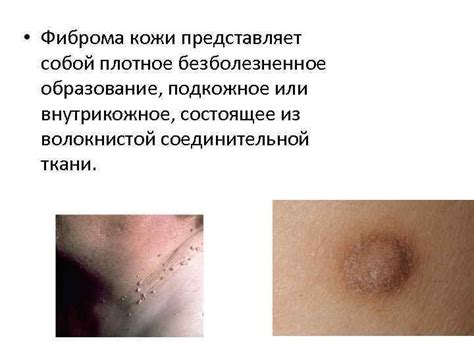 Истинная Фиброма Фибросаркома Студент Рахмонов Х А