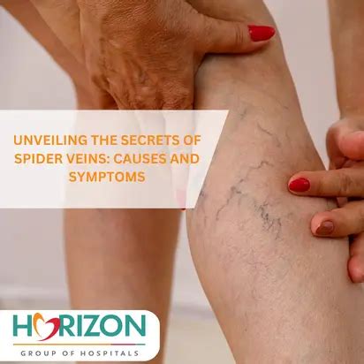 Secrets of spider veins: causes and symptoms