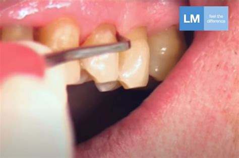 hoe scaler posterior lm dental