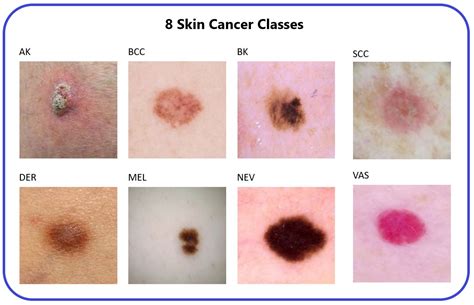 Naturalize Revolution: Unprecedented AI-Driven Precision in Skin Cancer