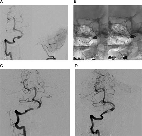 endovascular treatment  acute intracranial vertebral artery