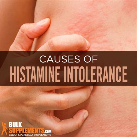 Histamine Allergy