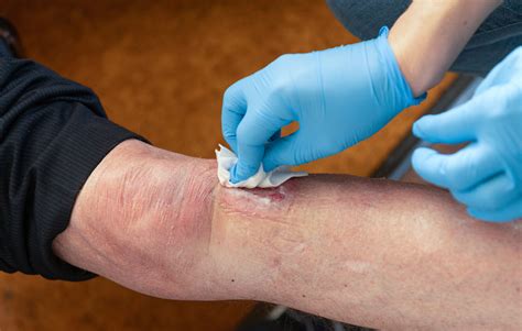 Wondifectie, het verschil tussen infectie en inflammatie