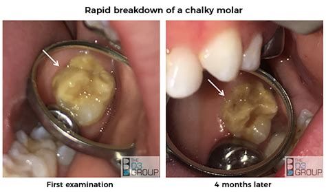 how to fix chalky teeth in adults