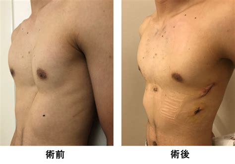 漏斗胸外来のお知らせ｜呼吸器外科の主な病気｜慶應義塾大学医学部呼吸器外科