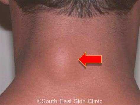 Sebaceous Cyst Diagram