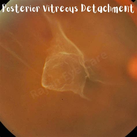 posterior vitreous detachment ophthalmobytes