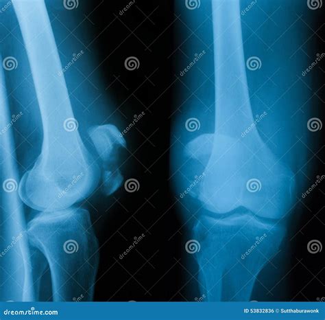 X-ray Image of Knee Joint, AP and Lateral View. Stock Photo - Image of