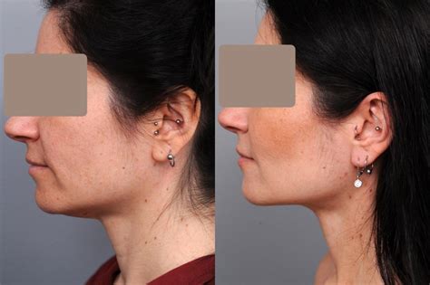 Smartlipo™ Neck Liposuction in New York - Dr. Sterry