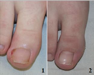 Partial Nail Avulsion - Nail Ftempo