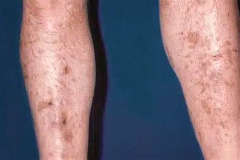 tcoyd guide  diabetic dermopathy ulcers skin care