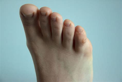 How To Treat A Corn On The Little Toe at Jon Lefebre blog