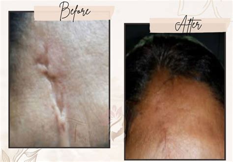 laser scar removal  kolkata acne scar removal  kolkata