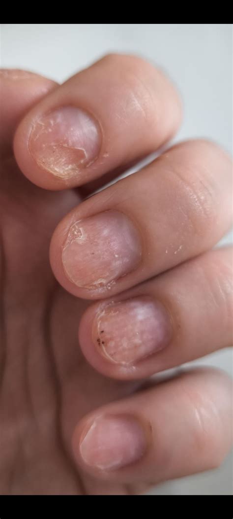 Nail Fungus: real advice from real people for healthy toenails and ...
