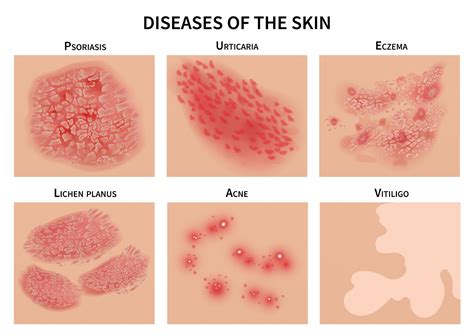 How to tell the difference between eczema and psoriasis, so you can get ...