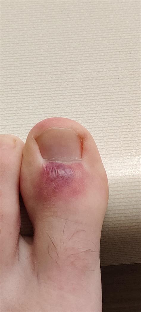 What Causes One Toe To Turn Purple at Isabella Jolly blog