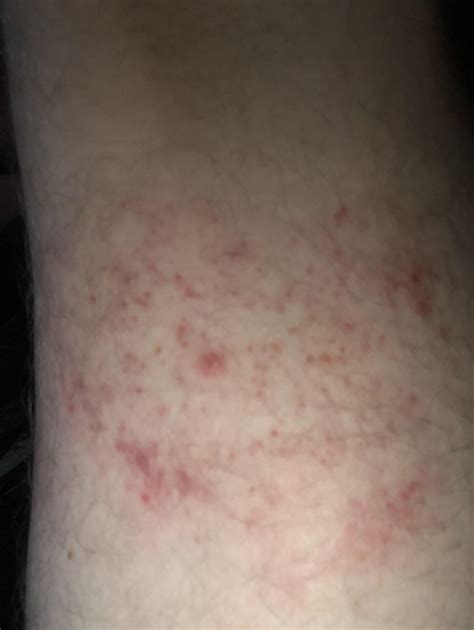 Baby Rashes On Legs