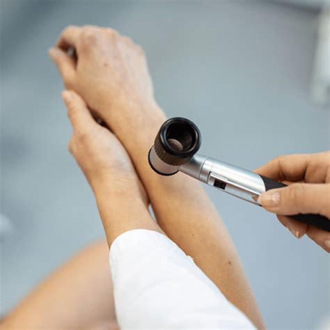 cyst removal  lehi utah smart skin dermatology