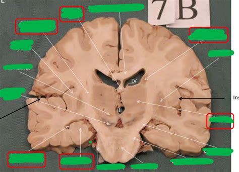 coronal brain  diagram quizlet