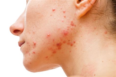 What Is Hormonal Cystic Acne? A Beauty Guide - Magazeeno