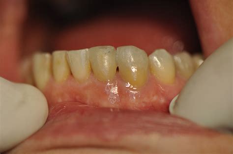 Dental implants in Sofia, Bulgaria at affordable prices