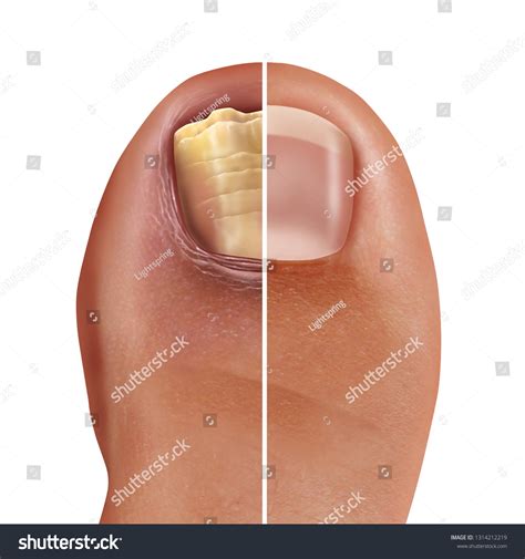 Toenails Showing Tinea Unguium Fungal Infections Stock Image M270