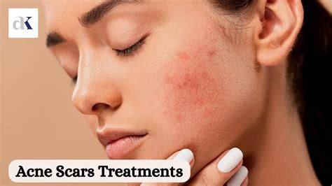 Revealing Acne Scars: Causes, Types, and Treatments