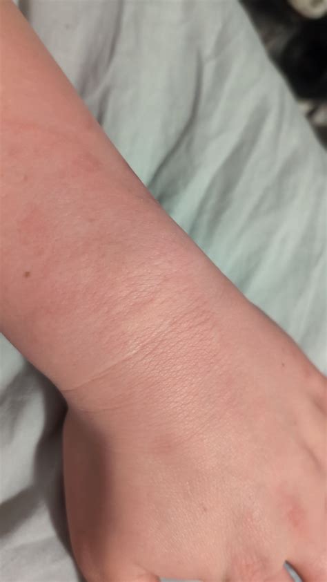 Signs of asbestos skin exposure : r/asbestoshelp