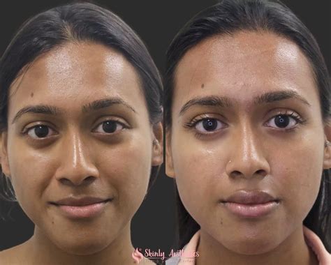 Smile Lines Treatment in London | Fillers for Laugh Lines