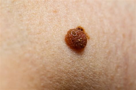 Understanding the ‘ABCDE’ Rule for Melanoma: A Simple Guide to Early D