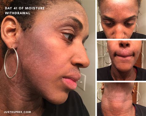 topical steroid withdrawal    month update  du pree