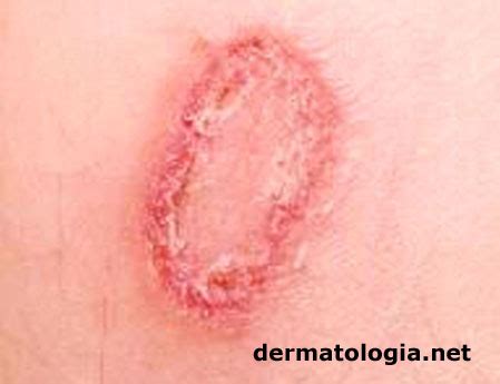 Fungo Na Pele É Contagioso - Fungo No Tratamento Da Pele