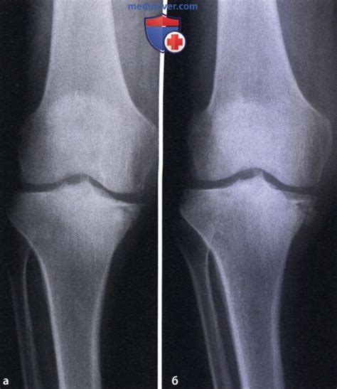 Вторичный остеоартроз коленного сустава: атлас фотографий