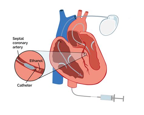 Nach Ablation Nicht Mehr Belastbar 1