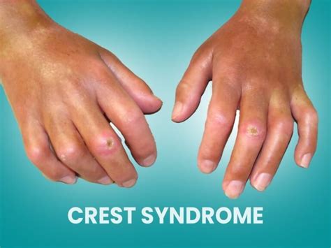 Understanding Crest Syndrome: A Complete Guide