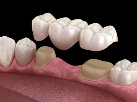 Illustration-of-three-unit-dental-bridge-in-Woodbridge-being-placed-on ...