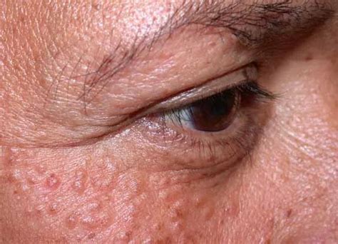 effective syringoma treatment options  clearer skin
