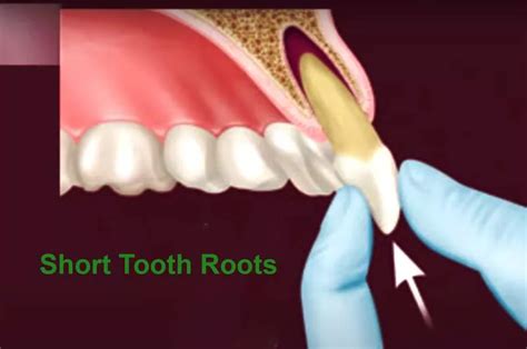 short tooth roots  closer    dental condition