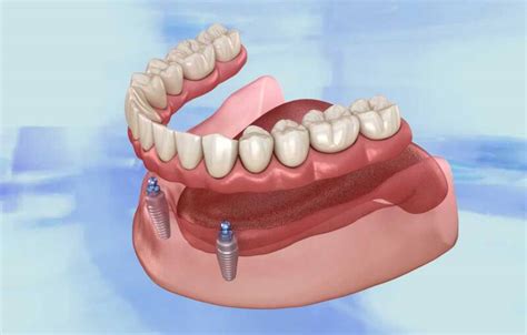 how to adjust partial dentures at home
