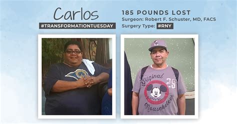 Before & After RNY with Carlos, down 185 pounds! : ObesityHelp