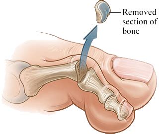 Foot Arthroplasty | MTP Joint Resection Arthroplasty | Florida Foot & Ankle