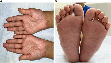 Frontiers | Case report: Corticosteroids as an adjunct treatment for