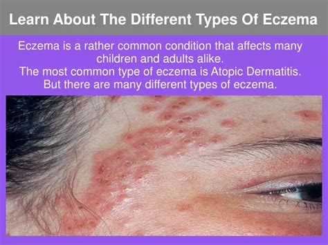 7 Types Of Eczema