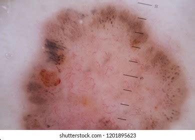 Basal Cell Skin Cancer Stock Photo 1201895623 | Shutterstock