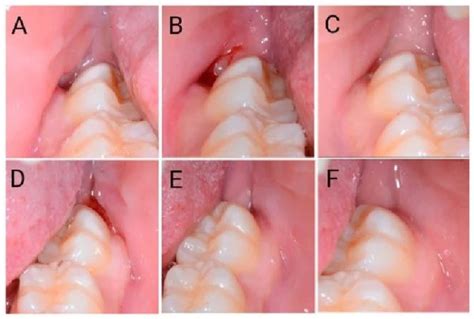 speed  wisdom teeth recovery expert tips   faster healing