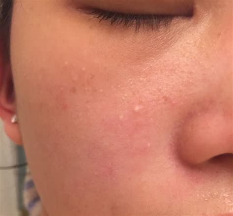 White Spots On Skin With Itching at Vincent Womack blog