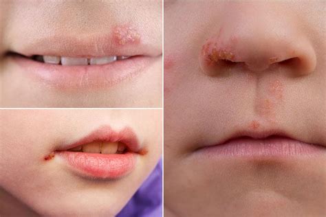 Cold Sore Rash On Face